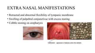 EXTRA NASAL MANIFESTATIONS
• Retracted and abnormal flexibility of tympanic membrane
• Swelling of palpebral conjunctivae with excess tearing
• Cobble stoning on oropharynx
 