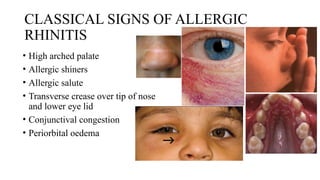 CLASSICAL SIGNS OF ALLERGIC
RHINITIS
• High arched palate
• Allergic shiners
• Allergic salute
• Transverse crease over tip of nose
and lower eye lid
• Conjunctival congestion
• Periorbital oedema
 