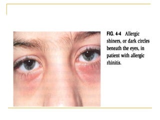 Vaso Rhinitis Allergic rhinitis & vasomotor rhinitis theory modified dr.bakshi-17.05.06