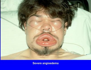 Severe angioedema
 