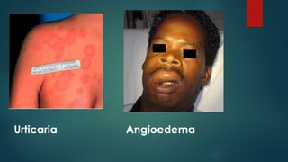 Urticaria Angioedema
 