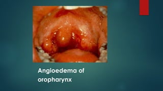 Angioedema of
oropharynx
 