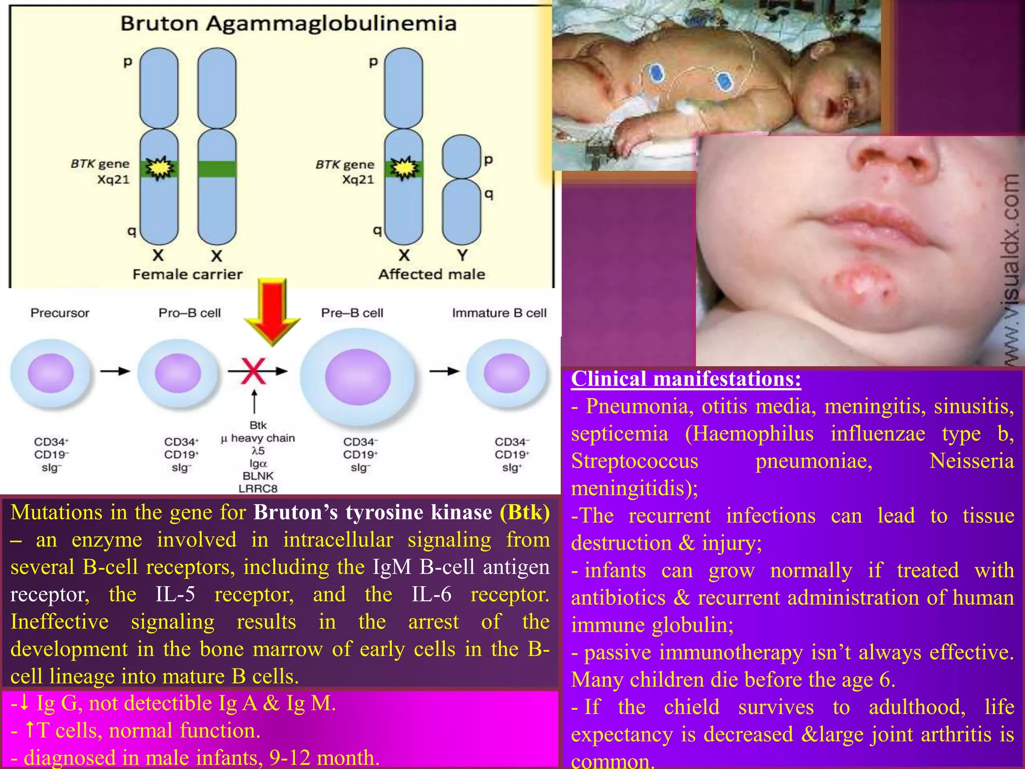 - Ig G, not detectible Ig A & Ig M.
- T cells, normal function.
- diagnosed in male infants, 9-12 month.
Clinical manifestations:
- Pneumonia, otitis media, meningitis, sinusitis,
septicemia (Haemophilus influenzae type b,
Streptococcus pneumoniae, Neisseria
meningitidis);
-The recurrent infections can lead to tissue
destruction & injury;
- infants can grow normally if treated with
antibiotics & recurrent administration of human
immune globulin;
- passive immunotherapy isn’t always effective.
Many children die before the age 6.
- If the chield survives to adulthood, life
expectancy is decreased &large joint arthritis is
common.
Mutations in the gene for Bruton’s tyrosine kinase (Btk)
– an enzyme involved in intracellular signaling from
several B-cell receptors, including the IgM B-cell antigen
receptor, the IL-5 receptor, and the IL-6 receptor.
Ineffective signaling results in the arrest of the
development in the bone marrow of early cells in the B-
cell lineage into mature B cells.
 