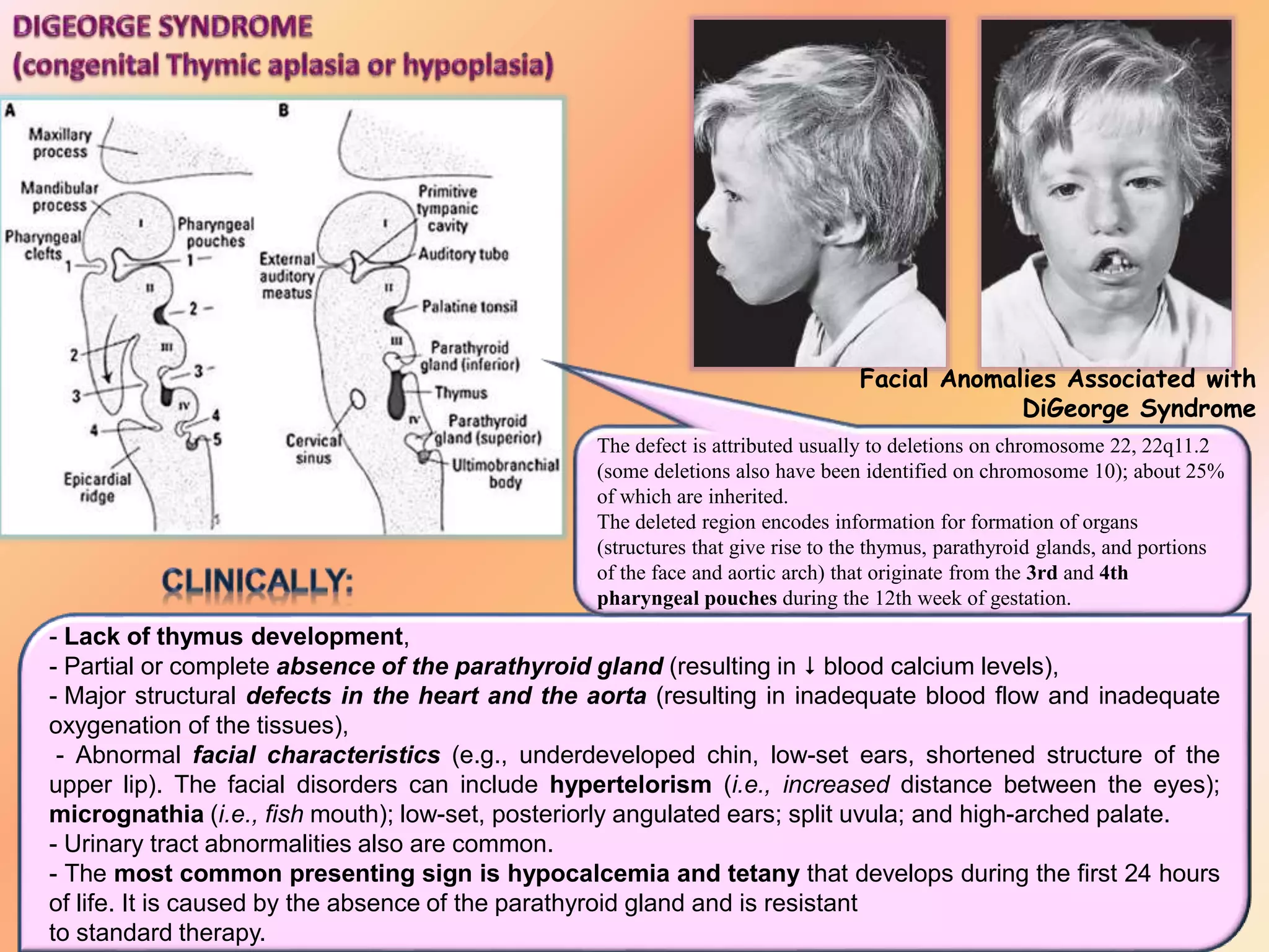 Facial Anomalies Associated with
DiGeorge Syndrome
- Lack of thymus development,
- Partial or complete absence of the parathyroid gland (resulting in  blood calcium levels),
- Major structural defects in the heart and the aorta (resulting in inadequate blood flow and inadequate
oxygenation of the tissues),
- Abnormal facial characteristics (e.g., underdeveloped chin, low-set ears, shortened structure of the
upper lip). The facial disorders can include hypertelorism (i.e., increased distance between the eyes);
micrognathia (i.e., fish mouth); low-set, posteriorly angulated ears; split uvula; and high-arched palate.
- Urinary tract abnormalities also are common.
- The most common presenting sign is hypocalcemia and tetany that develops during the first 24 hours
of life. It is caused by the absence of the parathyroid gland and is resistant
to standard therapy.
The defect is attributed usually to deletions on chromosome 22, 22q11.2
(some deletions also have been identified on chromosome 10); about 25%
of which are inherited.
The deleted region encodes information for formation of organs
(structures that give rise to the thymus, parathyroid glands, and portions
of the face and aortic arch) that originate from the 3rd and 4th
pharyngeal pouches during the 12th week of gestation.
 
