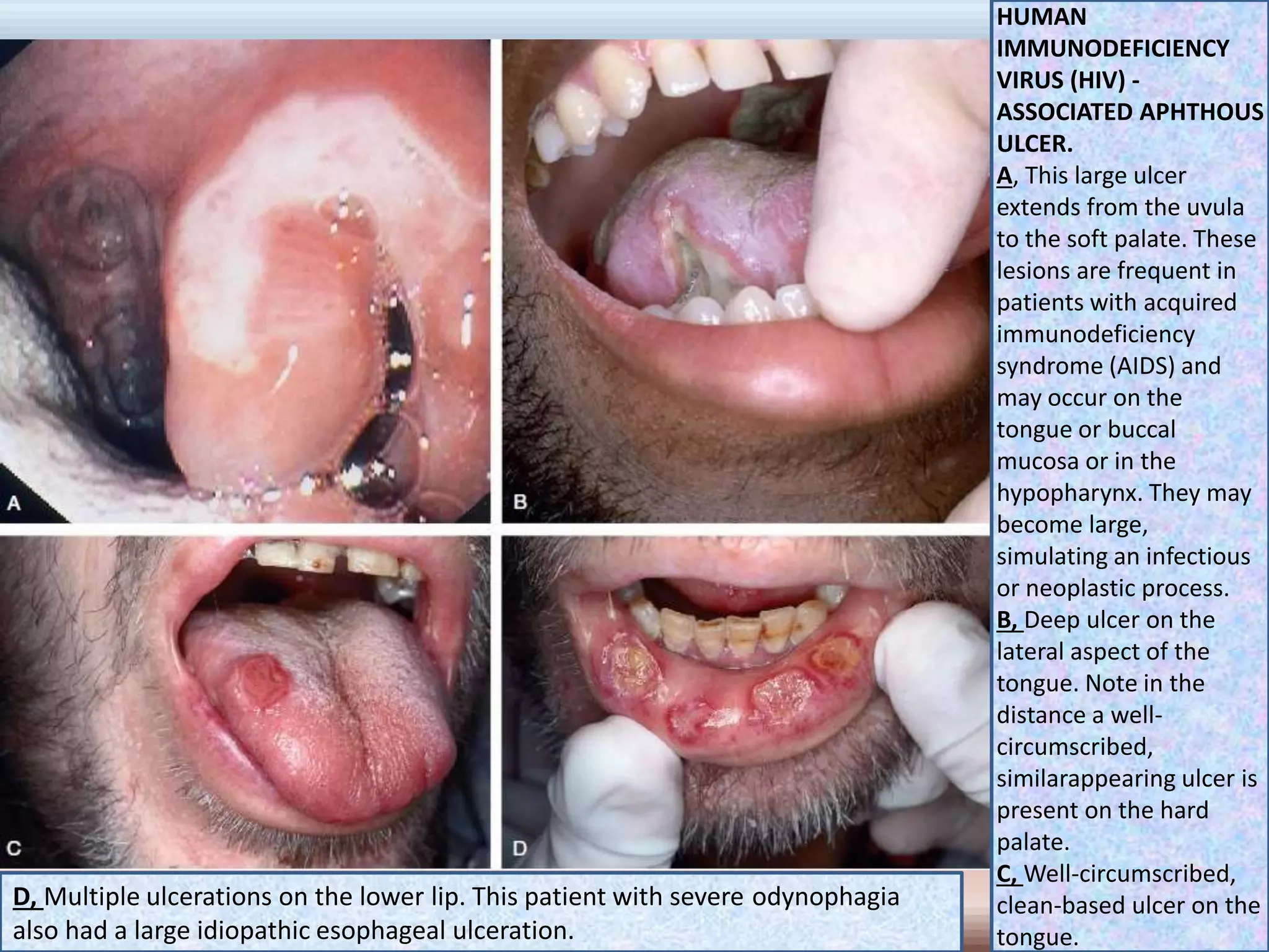 HUMAN
IMMUNODEFICIENCY
VIRUS (HIV) -
ASSOCIATED APHTHOUS
ULCER.
A, This large ulcer
extends from the uvula
to the soft palate. These
lesions are frequent in
patients with acquired
immunodeficiency
syndrome (AIDS) and
may occur on the
tongue or buccal
mucosa or in the
hypopharynx. They may
become large,
simulating an infectious
or neoplastic process.
B, Deep ulcer on the
lateral aspect of the
tongue. Note in the
distance a well-
circumscribed,
similarappearing ulcer is
present on the hard
palate.
C, Well-circumscribed,
clean-based ulcer on the
tongue.
D, Multiple ulcerations on the lower lip. This patient with severe odynophagia
also had a large idiopathic esophageal ulceration.
 