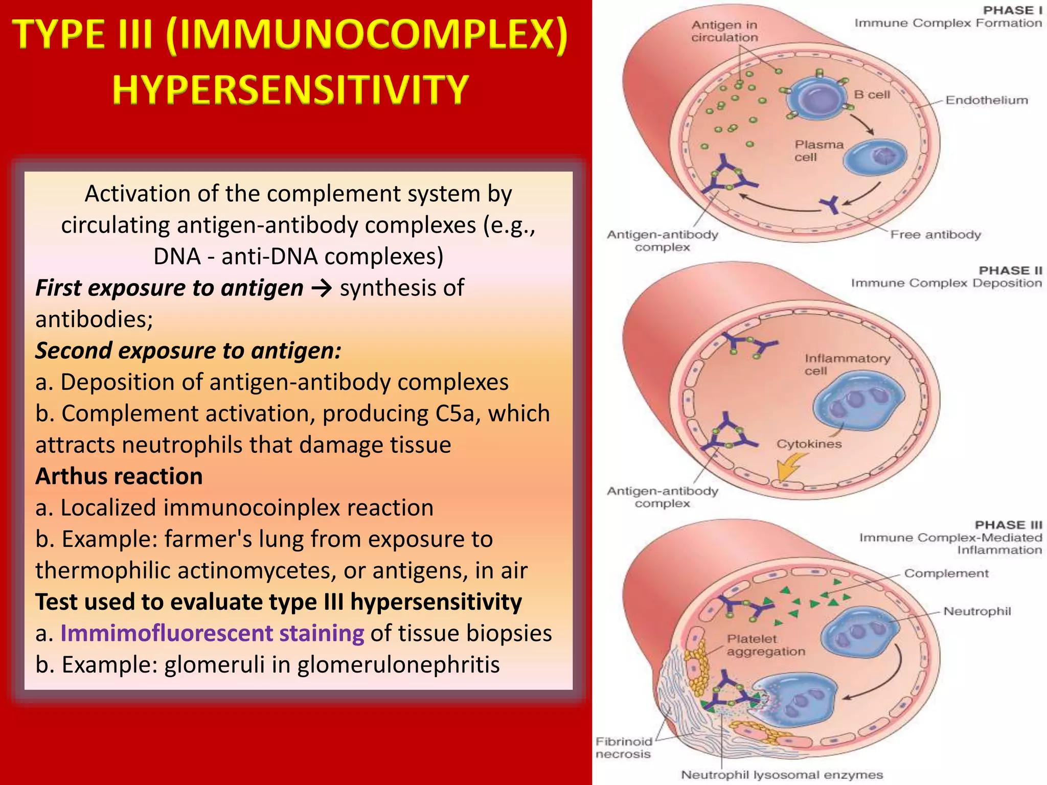 Activation of the complement system by
circulating antigen-antibody complexes (e.g.,
DNA - anti-DNA complexes)
First exposure to antigen → synthesis of
antibodies;
Second exposure to antigen:
a. Deposition of antigen-antibody complexes
b. Complement activation, producing C5a, which
attracts neutrophils that damage tissue
Arthus reaction
a. Localized immunocoinplex reaction
b. Example: farmer's lung from exposure to
thermophilic actinomycetes, or antigens, in air
Test used to evaluate type III hypersensitivity
a. Immimofluorescent staining of tissue biopsies
b. Example: glomeruli in glomerulonephritis
TYPE III (IMMUNOCOMPLEX)
HYPERSENSITIVITY
 