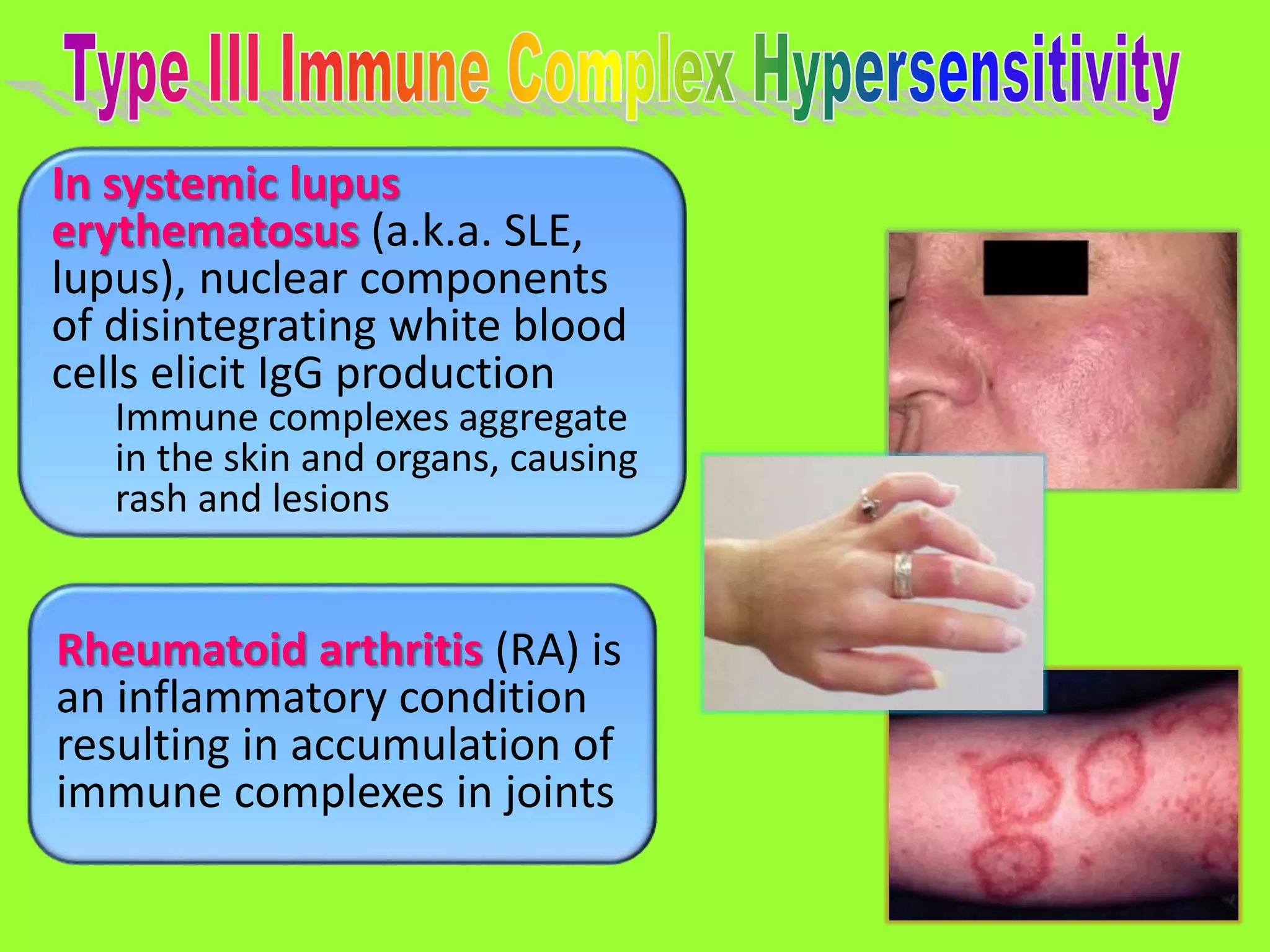 71
In systemic lupus
erythematosus (a.k.a. SLE,
lupus), nuclear components
of disintegrating white blood
cells elicit IgG production
Immune complexes aggregate
in the skin and organs, causing
rash and lesions
Rheumatoid arthritis (RA) is
an inflammatory condition
resulting in accumulation of
immune complexes in joints
 
