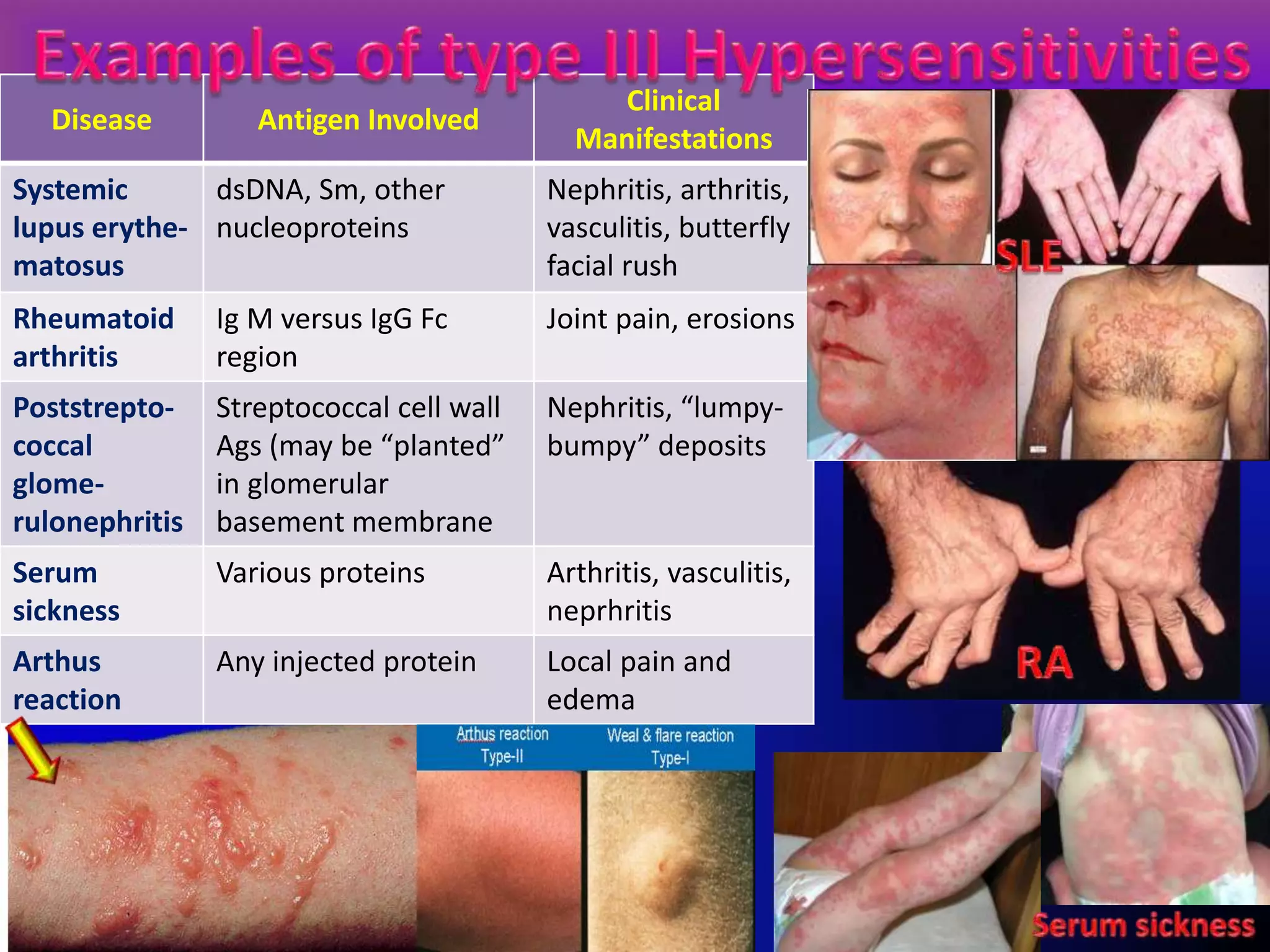 Disease Antigen Involved
Clinical
Manifestations
Systemic
lupus erythe-
matosus
dsDNA, Sm, other
nucleoproteins
Nephritis, arthritis,
vasculitis, butterfly
facial rush
Rheumatoid
arthritis
Ig M versus IgG Fc
region
Joint pain, erosions
Poststrepto-
coccal
glome-
rulonephritis
Streptococcal cell wall
Ags (may be “planted”
in glomerular
basement membrane
Nephritis, “lumpy-
bumpy” deposits
Serum
sickness
Various proteins Arthritis, vasculitis,
neprhritis
Arthus
reaction
Any injected protein Local pain and
edema
 