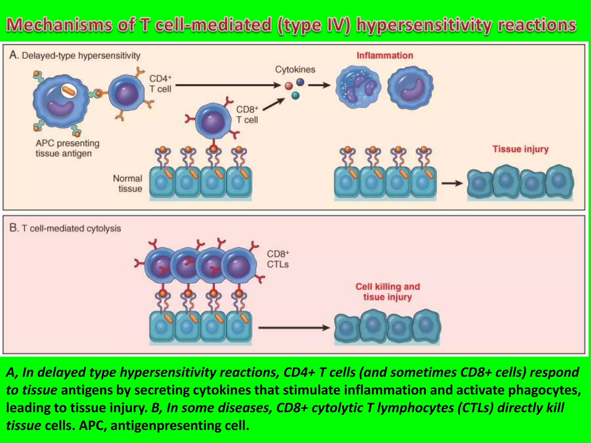 A, In delayed type hypersensitivity reactions, CD4+ T cells (and sometimes CD8+ cells) respond
to tissue antigens by secreting cytokines that stimulate inflammation and activate phagocytes,
leading to tissue injury. B, In some diseases, CD8+ cytolytic T lymphocytes (CTLs) directly kill
tissue cells. APC, antigenpresenting cell.
 