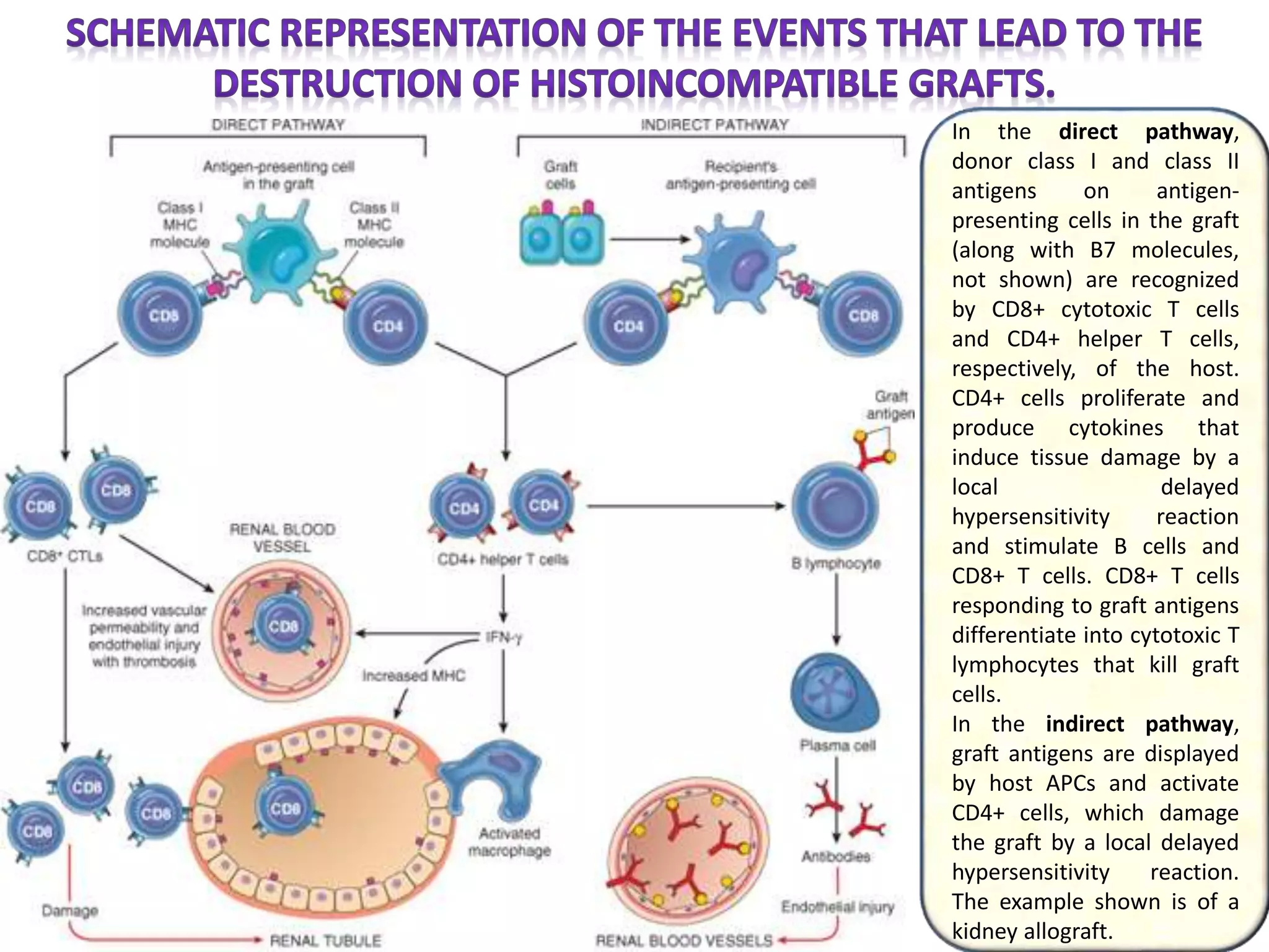 In the direct pathway,
donor class I and class II
antigens on antigen-
presenting cells in the graft
(along with B7 molecules,
not shown) are recognized
by CD8+ cytotoxic T cells
and CD4+ helper T cells,
respectively, of the host.
CD4+ cells proliferate and
produce cytokines that
induce tissue damage by a
local delayed
hypersensitivity reaction
and stimulate B cells and
CD8+ T cells. CD8+ T cells
responding to graft antigens
differentiate into cytotoxic T
lymphocytes that kill graft
cells.
In the indirect pathway,
graft antigens are displayed
by host APCs and activate
CD4+ cells, which damage
the graft by a local delayed
hypersensitivity reaction.
The example shown is of a
kidney allograft.
 