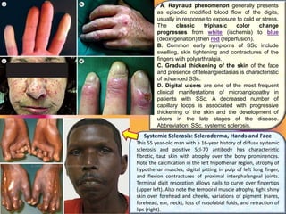 A. Raynaud phenomenon generally presents
as episodic modified blood flow of the digits,
usually in response to exposure to cold or stress.
The classic triphasic color change
progresses from white (ischemia) to blue
(deoxygenation) then red (reperfusion).
B. Common early symptoms of SSc include
swelling, skin tightening and contractures of the
fingers with polyarthralgia.
C. Gradual thickening of the skin of the face
and presence of teleangiectasias is characteristic
of advanced SSc.
D. Digital ulcers are one of the most frequent
clinical manifestations of microangiopathy in
patients with SSc. A decreased number of
capillary loops is associated with progressive
thickening of the skin and the development of
ulcers in the late stages of the disease.
Abbreviation: SSc, systemic sclerosis.
Systemic Sclerosis: Scleroderma, Hands and Face
This 55 year-old man with a 16-year history of diffuse systemic
sclerosis and positive Scl-70 antibody has characteristic
fibrotic, taut skin with atrophy over the bony prominences.
Note the calcification in the left hypothenar region, atrophy of
hypothenar muscles, digital pitting in pulp of left long finger,
and flexion contractures of proximal interphalangeal joints.
Terminal digit resorption allows nails to curve over fingertips
(upper left). Also note the temporal muscle atrophy, tight shiny
skin over forehead and cheeks, variations of pigment (nares,
forehead, ear, neck), loss of nasolabial folds, and retraction of
lips (right).
 