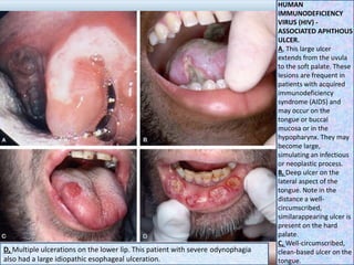 HUMAN
IMMUNODEFICIENCY
VIRUS (HIV) -
ASSOCIATED APHTHOUS
ULCER.
A, This large ulcer
extends from the uvula
to the soft palate. These
lesions are frequent in
patients with acquired
immunodeficiency
syndrome (AIDS) and
may occur on the
tongue or buccal
mucosa or in the
hypopharynx. They may
become large,
simulating an infectious
or neoplastic process.
B, Deep ulcer on the
lateral aspect of the
tongue. Note in the
distance a well-
circumscribed,
similarappearing ulcer is
present on the hard
palate.
C, Well-circumscribed,
clean-based ulcer on the
tongue.
D, Multiple ulcerations on the lower lip. This patient with severe odynophagia
also had a large idiopathic esophageal ulceration.
 