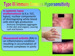 71
In systemic lupus
erythematosus (a.k.a. SLE,
lupus), nuclear components
of disintegrating white blood
cells elicit IgG production
Immune complexes aggregate
in the skin and organs, causing
rash and lesions
Rheumatoid arthritis (RA) is
an inflammatory condition
resulting in accumulation of
immune complexes in joints
 