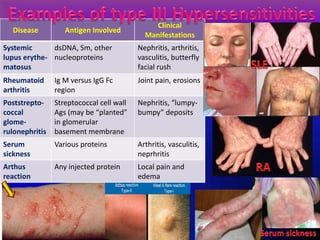 Disease Antigen Involved
Clinical
Manifestations
Systemic
lupus erythe-
matosus
dsDNA, Sm, other
nucleoproteins
Nephritis, arthritis,
vasculitis, butterfly
facial rush
Rheumatoid
arthritis
Ig M versus IgG Fc
region
Joint pain, erosions
Poststrepto-
coccal
glome-
rulonephritis
Streptococcal cell wall
Ags (may be “planted”
in glomerular
basement membrane
Nephritis, “lumpy-
bumpy” deposits
Serum
sickness
Various proteins Arthritis, vasculitis,
neprhritis
Arthus
reaction
Any injected protein Local pain and
edema
 