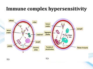 Immune complex hypersensitivity
 