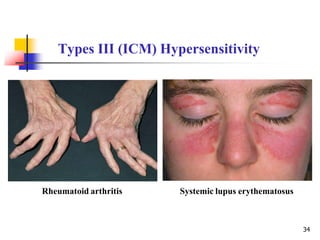 34
Types III (ICM) Hypersensitivity
Rheumatoid arthritis Systemic lupus erythematosus
 