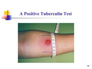 A Positive Tuberculin Test
40
 