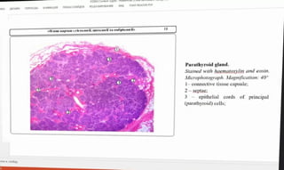 BKA OAH EPEXOIM AHMALIMR noKA3 CAAVUIOBPELUEHMPOBAHME BSM FOXaT READER POF
pem-KapKat Heraoil, UEraOFT TA eMOpia. 0t»
Parathyroid gland.
Stained with haematoxylin and eosin.
Microphotograph. Magnification: 40
1- connective tissue capsule;
2-septae
3- epithelial cords
of principal
(parathyroid) cells;
TK KCA
 