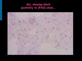 ALL showing block
positivity to (PAS) stain..
 