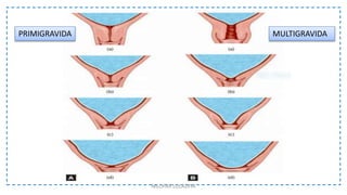 NILOFAR LOLADIYA
PRIMIGRAVIDA MULTIGRAVIDA
 