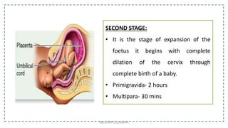 SECOND STAGE:
• It is the stage of expansion of the
foetus it begins with complete
dilation of the cervix through
complete birth of a baby.
• Primigravida- 2 hours
• Multipara- 30 mins
NILOFAR LOLADIYA
 