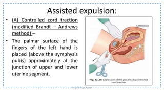 Assisted expulsion:
• (A) Controlled cord traction
(modified Brandt – Andrews
method) –
• The palmar surface of the
fingers of the left hand is
placed (above the symphysis
pubis) approximately at the
junction of upper and lower
uterine segment.
NILOFAR LOLADIYA
 