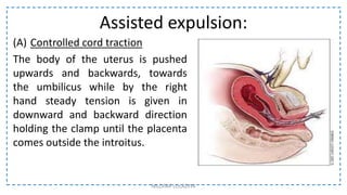 Assisted expulsion:
(A) Controlled cord traction
The body of the uterus is pushed
upwards and backwards, towards
the umbilicus while by the right
hand steady tension is given in
downward and backward direction
holding the clamp until the placenta
comes outside the introitus.
NILOFAR LOLADIYA
 