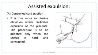 Assisted expulsion:
(A) Controlled cord traction
• It is thus more an uterine
elevation which facilitates
expulsion of the placenta.
The procedure is to be
adopted only when the
uterus is hard and
contracted.
NILOFAR LOLADIYA
 