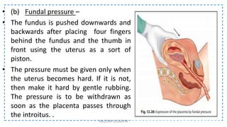 • (b) Fundal pressure –
• The fundus is pushed downwards and
backwards after placing four fingers
behind the fundus and the thumb in
front using the uterus as a sort of
piston.
• The pressure must be given only when
the uterus becomes hard. If it is not,
then make it hard by gentle rubbing.
The pressure is to be withdrawn as
soon as the placenta passes through
the introitus. .
NILOFAR LOLADIYA
 