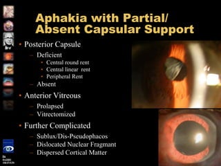 Instruction course-Secondary posterior chamber IOL (PC IOL ...