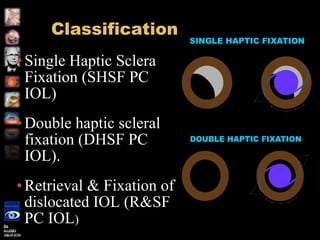 Instruction course-Secondary posterior chamber IOL (PC IOL ...