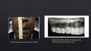 Composite defect :pateitn’s missing teeth ,
soft tissue and hard tissue mass
Vertical dimension in occlusion (VDO)
 