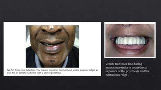 Visible transition line during
animation results in unaesthetic
exposure of the prosthesis and the
edentulous ridge .
 