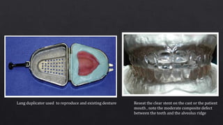 Lang duplicator used to reproduce and existing denture Reseat the clear stent on the cast or the patient
mouth , note the moderate composite defect
between the teeth and the alveolus ridge
 