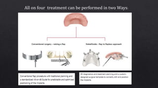 All on four treatment can be performed in two Ways:
 