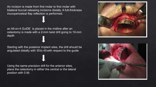 An incision is made from first molar to first molar with
bilateral buccal releasing incisions distally. A full-thickness
mucoperiosteal flap reflection is performed.
an All-on-4 GuiDE is placed in the midline after an
osteotomy is made with a 2-mm twist drill going to 10-mm
depth
Starting with the posterior implant sites, the drill should be
angulated distally with 30to 45with respect to the guide
Using the same precision drill for the anterior sites,
place the osteotomy in either the central or the lateral
position with 0 tilt.
 