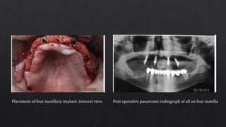 Placement of four maxillary implant :introral view Post operative panaromic radiograph of all on four maxilla
 