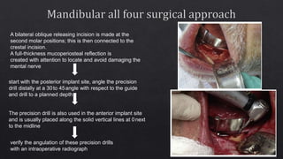 A bilateral oblique releasing incision is made at the
second molar positions; this is then connected to the
crestal incision.
A full-thickness mucoperiosteal reflection is
created with attention to locate and avoid damaging the
mental nerve
start with the posterior implant site, angle the precision
drill distally at a 30to 45angle with respect to the guide
and drill to a planned depth
The precision drill is also used in the anterior implant site
and is usually placed along the solid vertical lines at 0next
to the midline
verify the angulation of these precision drills
with an intraoperative radiograph
 