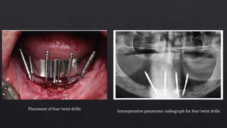 Placement of four twist drills
Intraoperative panaromic radiograph for four twist drills
 