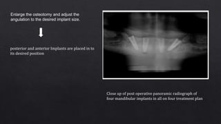Enlarge the osteotomy and adjust the
angulation to the desired implant size.
posterior and anterior Implants are placed in to
its desired position
Close up of post operative panoramic radiograph of
four mandibular implants in all on four treatment plan
 