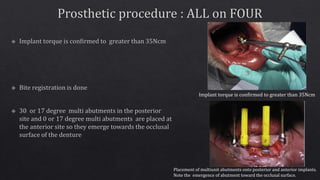 Implant torque is confirmed to greater than 35Ncm
Placement of multiunit abutments onto posterior and anterior implants.
Note the emergence of abutment toward the occlusal surface.
 