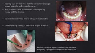 Lute the tissue-baring surface of the denture to the
temporary coping (multiunit) with self cure acrylic
 