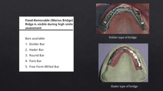 Dolder type of bridge
Hader type of bridge
 