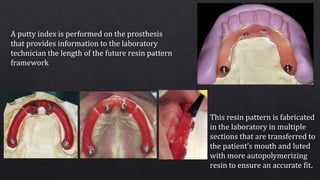 A putty index is performed on the prosthesis
that provides information to the laboratory
technician the length of the future resin pattern
framework
This resin pattern is fabricated
in the laboratory in multiple
sections that are transferred to
the patient’s mouth and luted
with more autopolymerizing
resin to ensure an accurate fit.
 