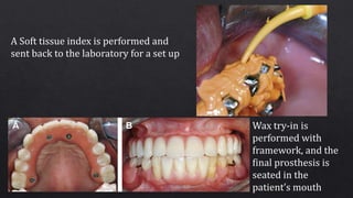 A Soft tissue index is performed and
sent back to the laboratory for a set up
Wax try-in is
performed with
framework, and the
final prosthesis is
seated in the
patient’s mouth
 