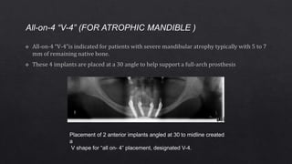 All-on-4 “V-4” (FOR ATROPHIC MANDIBLE )
Placement of 2 anterior implants angled at 30 to midline created
a
V shape for “all on- 4” placement, designated V-4.
 