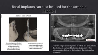 They are single piece implants in which the implant and
the abutment are fused in to one single piece . This
minimizes the failure of the implants due to interface
problems
 