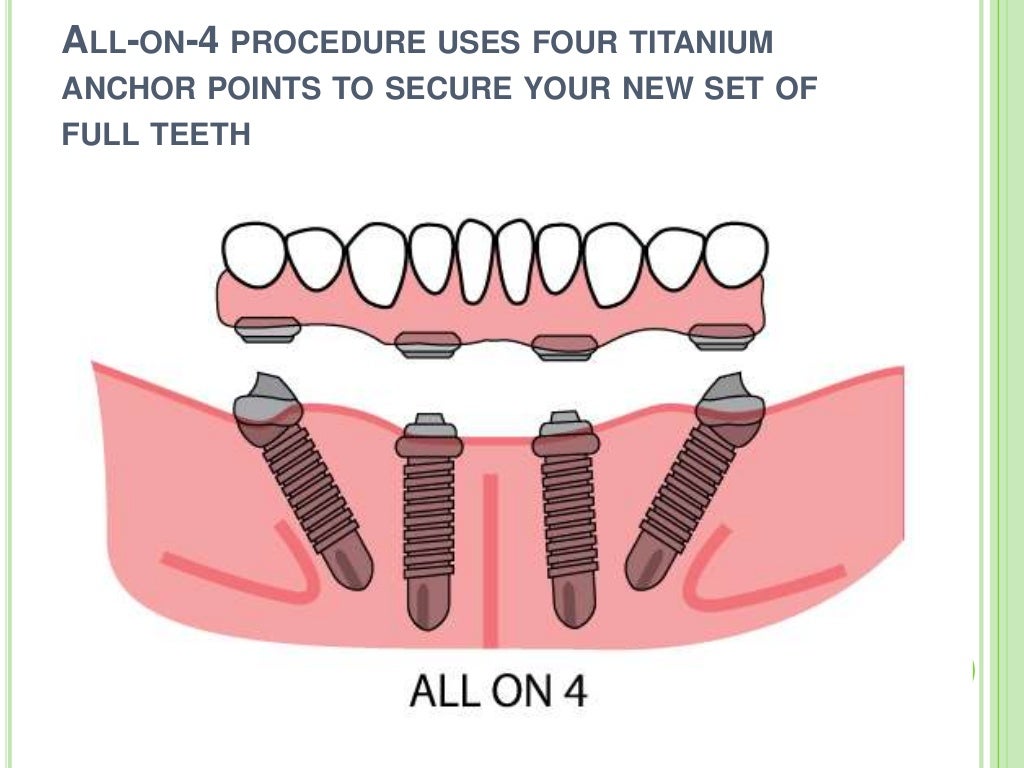 All On 4 Dental Implant Solutions
