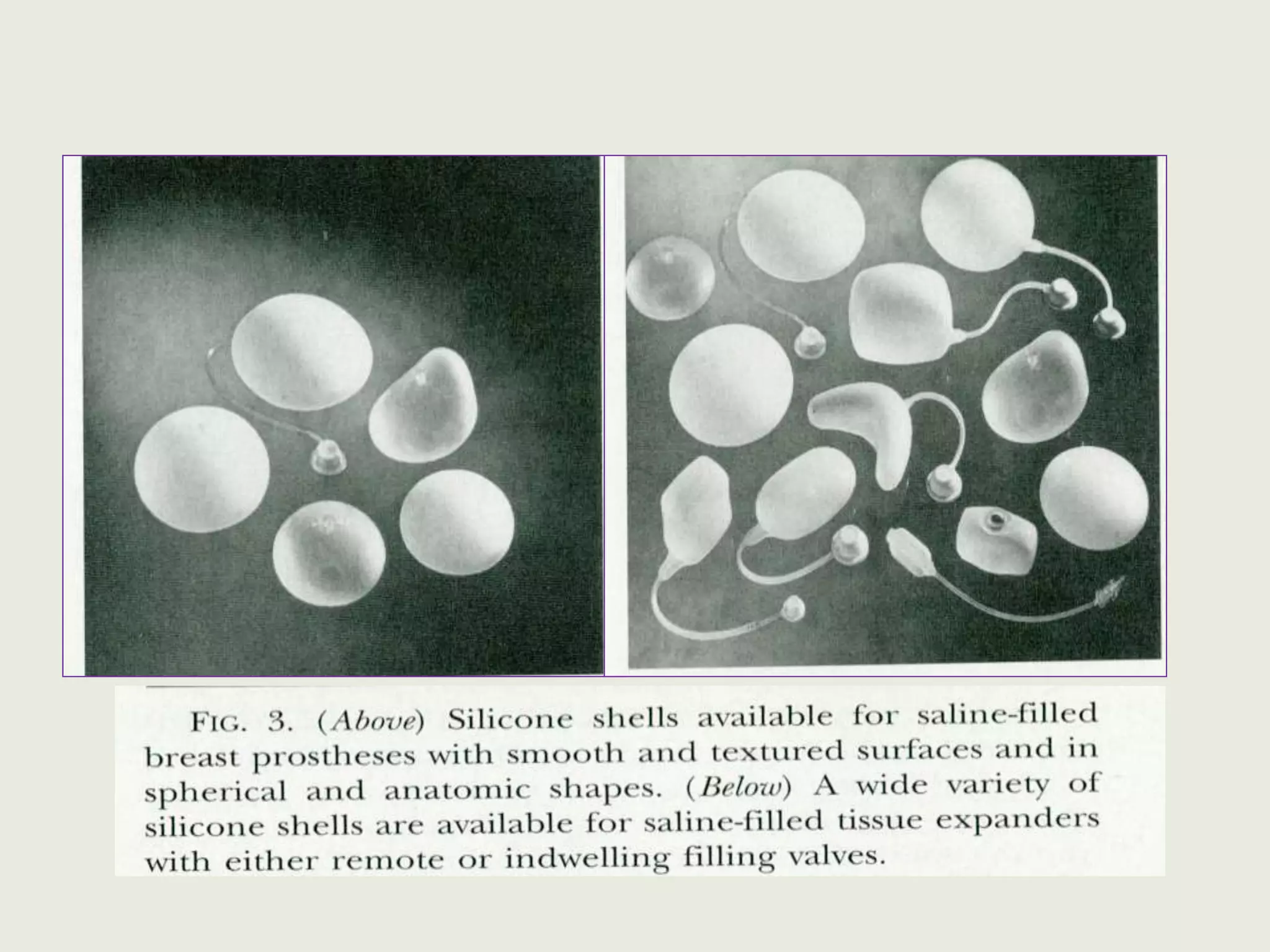Alloplastic materials | PPTX