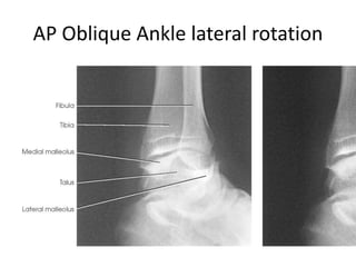 Lateral Rotation Of Ankle Rotation All projections Anatomy | PPTX